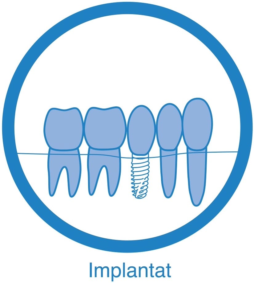 implantat- privat tandläkare i Västerås